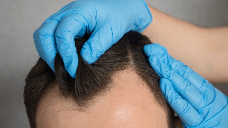 Affordable Hair Transplant Turkey – Sapphire Hair Clinic
