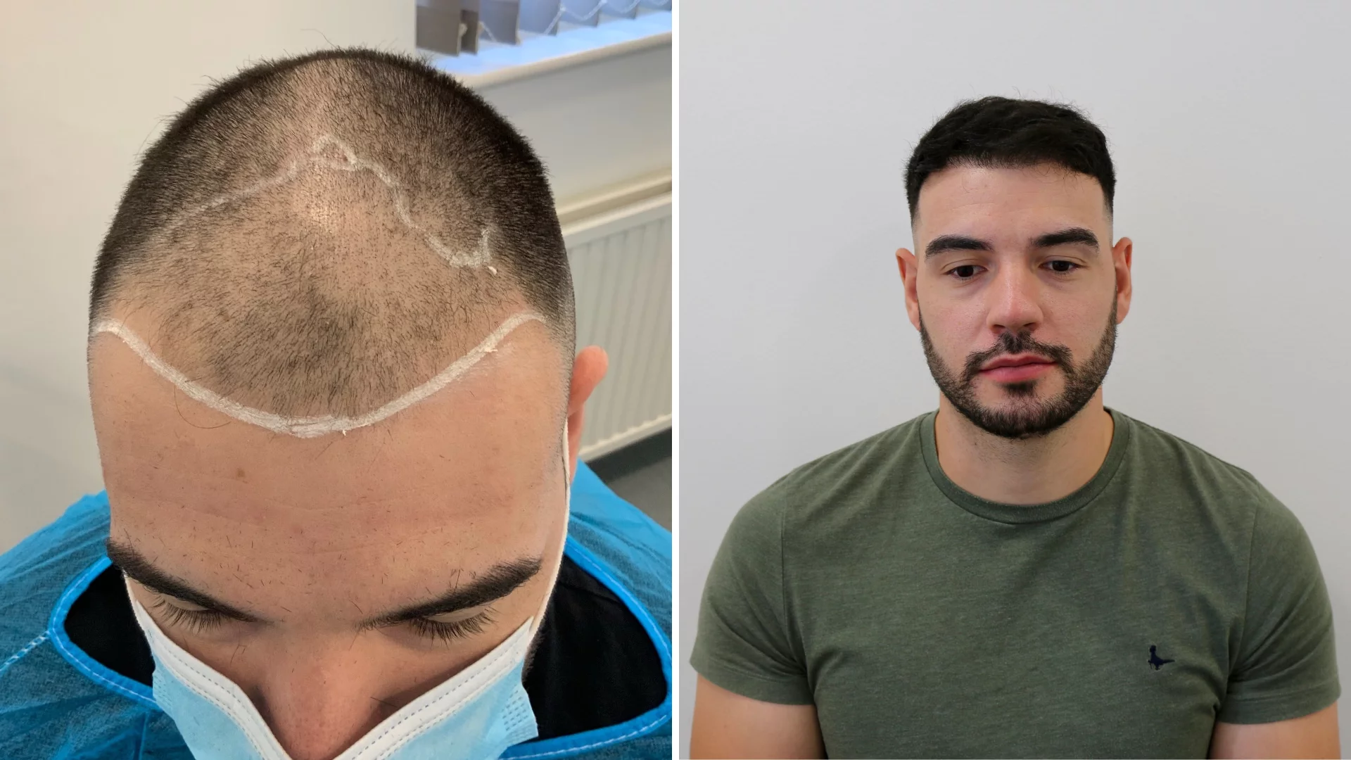 Hair Transplant UK – Restore Confidence with the Experts