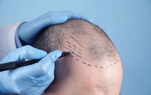 Hair Transplant Turkey Cost: Everything You Need to Know